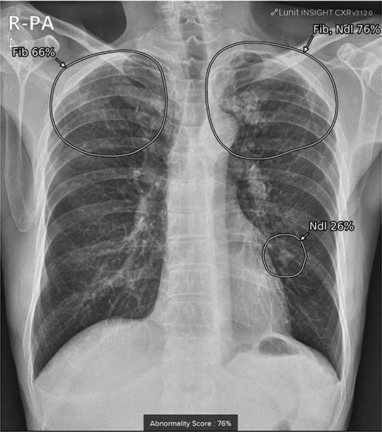 AI detects incidental lung nodules on chest xrays Radiology AI